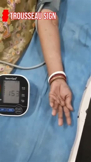 Medicos Nexus on Instagram: "✋ Trousseau Sign ⚡ 🔹 What is it? 👉 A clinical sign of latent hypocalcemia 🧪 👉 Indicates ↑ neuromuscular excitability 🩺 How to elicit ✔ BP cuff 🩸 on upper arm ✔ Inflate 20–30 mmHg ↑ SBP ✔ Maintain for 3–5 min ⏱ ➡ Positive sign = Carpopedal spasm ✊ ✋ Hand posture (Main d’accoucheur) 🔸 Wrist flexion ↘ 🔸 MCP flexion 🔸 IP joint extension 🔸 Thumb adduction 👍➡ 🧠 Why does it occur? ⬇ Ionized Ca²⁺ (not total Ca!) ⬆ Na⁺ channel excitability ⚡ 🩸 Ischemia + alkalosi