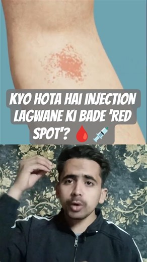 Injection Side Effects: Red Spots on Skin Explained 🔴🩸#medicalknowledge #doctoradvice #injection