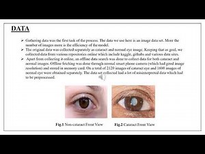 74-Automated Detection of Cataract Using Deep Learning Technique