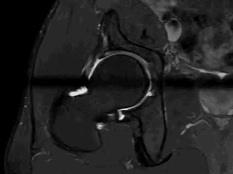 Mri hip arthrography radial sequence