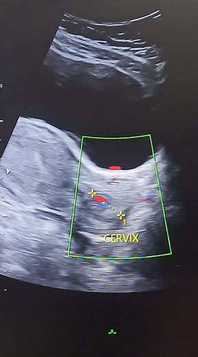 pelvic pathology #sonographiccasestudy #radiology #Ultrasound #sonographer #learning #reelsvideo #reelsfacebook | Sonographic case study