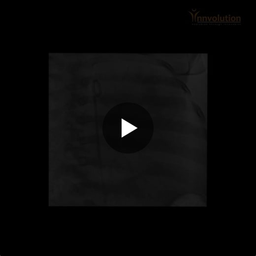 #innvolution #premierelite #cathlab #interventionalcardiology #clinicalexcellence #patientsafety #innovationinhealthcare #madeinindia | Innvolution Healthcare Private Limited