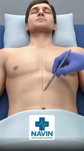 Navin Healthcare Solutions on Instagram: "Hemodialysis is a treatment used when the kidneys cannot properly filter waste from the blood. First, doctors create a vascular access—usually an arteriovenous fistula in the arm—so blood can flow easily to the machine. 🏥 Navin Health Care Solutions Trusted support for cashless dialysis & hospital admission in Delhi-NCR 📞 Call / WhatsApp: +91 8755202215 👤 Mr. Navin Kumar https://www.navinhealthcaresolutions.com #MedicalEducation #KidneyHealth #Dialysi