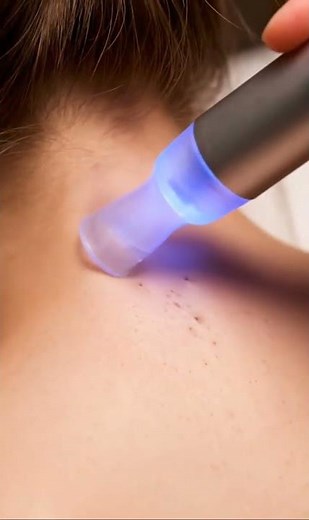 Minimal Blackhead Removal | Back Neck ASMR #macroasmr #skincare #asmr #satisfying #skincareroutine