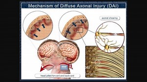5 Hal yang Perlu Diketahui tentang Diffuse Axonal Injury, Pengertian hingga Kemungkinan untuk Sembuh - Tribunnews.com