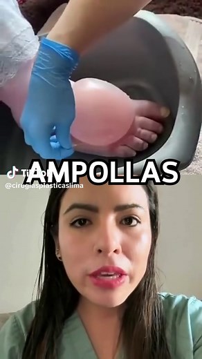 Manejo de ampollas en quemaduras de segundo grado