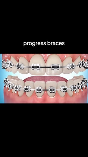 Braces for Kids: Tips and Process for Children Aged 9-10