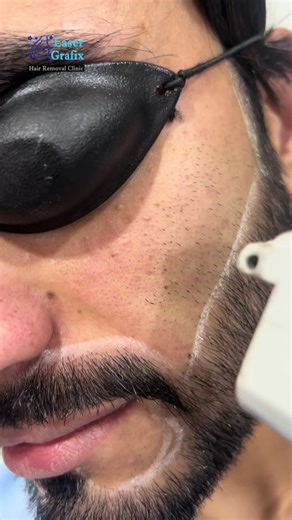 Affordable Laser Hair Removal Offers for Ramadan