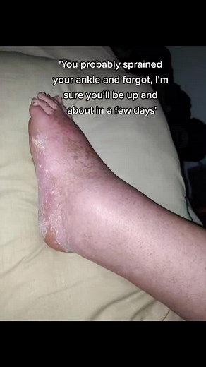 it's been a long 12 years but in 2 months it'll all be over 🦿#amputation #amputee #chronicillness #disabled #disability #crps #rsd #surgery