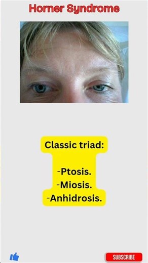 One Pupil Smaller? Horner Syndrome Made Simple | Sympathetic Lesion #shorts