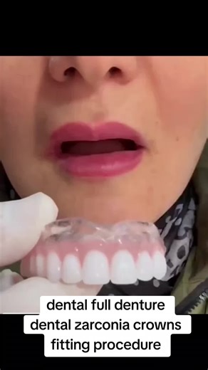 Full Upper Denture and Veneers Procedure Explained