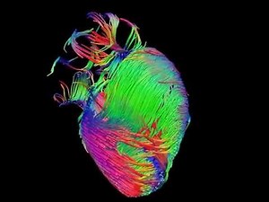 Diffusion tensor imaging (via MRI) of the heart