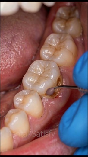How to Clean Your Teeth Properly | Dental Care Tips