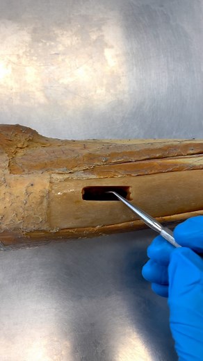 Institute of Human Anatomy | Medullary Cavity: Your Bones Store Fat #anatomy101 #bones #cadaverlab #learnonig #knowyourbody #nowyouknow | Instagram