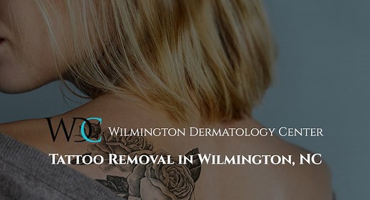 Tattoo Removal in Wilmington, NC | Laser Tattoo Removal