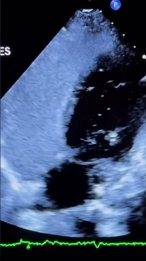 Positive Bubble Study #echocardiogram #echocardiography #cardiology