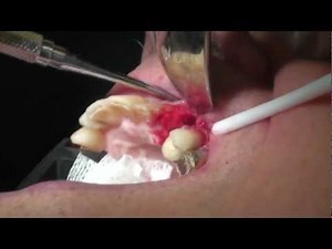Motorized Periotome For Atraumatic Extractions • Video • MEDtube.net