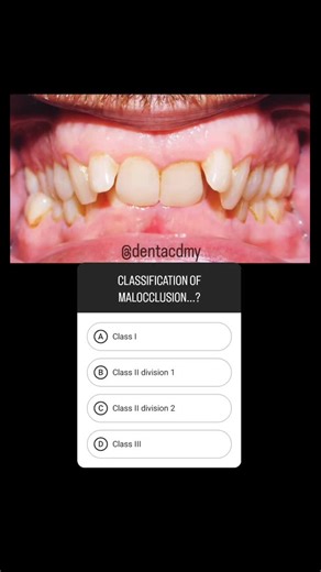 Dent Academy on Instagram: "What classification of malocclusion can you see in the picture above?樂 . . Follow for more ;) . . . #dental #malocclusion #classification #dentistry"