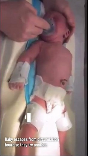 The torture of American men became assembly line with Goldstein's invention the Gomco clamp in 1935.