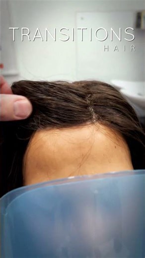 Female Hair Loss Transformation | Natural Hairline Restoration (Non-Surgical)