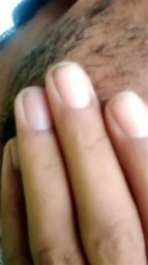 #pimple #skin #skin #skin #skin #satisfying #extraction