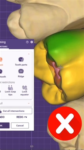 Mohamed shehab on Instagram: "Exocad tips👌✨#dental_student #dental_technician #exocad #dental #dentist #dentistry #explorepage✨ #explore t"