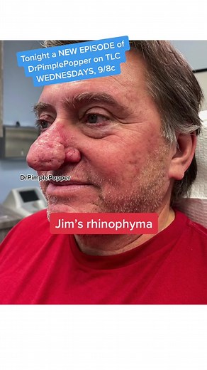 Dr Pimple Popper: New Episode Tonight on TLC!