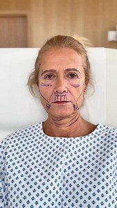 ✅ Deep plane facelift ✅ Deep necklift ✅ Bullhorn lip lift ✅ Lower blepharoplasty ⏰ 2 weeks after surgery 💉 Under local anesthesia combined with analgosedation 👩🏼 Age 67 years 👨🏻‍⚕️ @tomasventruba 📍V-CLINIC - Brno, Czech republic | V-Clinic