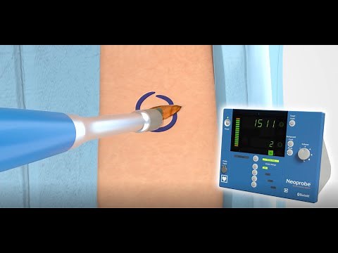 Neoprobe® Melanoma Procedure Animation