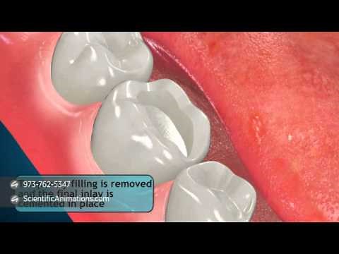 Tooth Restoration Procedures - Inlay