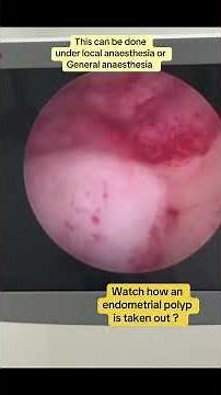 Womens Health: Endometrial Polyp Removal Procedure #womenshealth