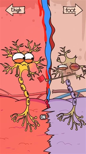 palak♥️ on Instagram: "Phantom Limb Pain-or something else? . After amputation, the brain and nerves can misfire, creating real pain in the missing part (phantom limb pain), often burning, stabbing, cramping, or "pins & needles." It's distinct from residual limb pain (skin, neuroma, prosthesis fit) and from CRPS or radiculopathy. Drivers include neuroma hyper-excitability, spinal "central sensitization," and cortical remapping; stress, poor sleep, and stump pressure can flare it. Red flags for "