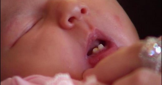 Baby born with two front teeth