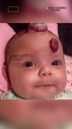 Understanding Infantile Haemangioma in Newborns