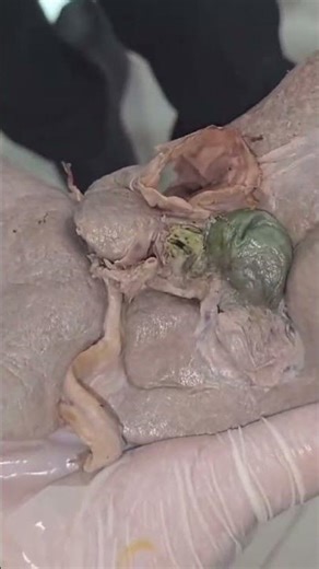mbbs student practice on human liver 😲😯😮#medical #shortvideo #neet