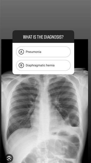 Diagnosis ✅ comments follow me ✅ #drmhmedical #knowledge #doctor #practice #medicalstudent #viralshorts #viralreels #xray #pneumonia | Dr.mhmedical