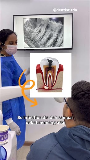 The Dental Atelier on Instagram: "Toothache alert! 😬 A case of advanced tooth decay has reached the pulp 🦷💦. Two options on the table: root canal treatment or extraction. Prioritizing oral health is key. Consult your dentist to determine the best course of action. ✅ #OralHealthMatters #ToothCare #DentalHealth Which option do you prefer? 🤔🤔"