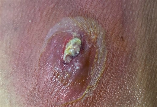 Volcanic Infected Cyst Incision and Drainage
