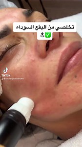 2.1K views · 37 reactions | Meso Micronnedling Treatment offers more visible benefits than most other facial treatments. 朗It provides immediate coverage and long-lasting beauty without overstimulating the skin. The results are visible wrinkle improvement, even skin tone, and glow all at the same time. | Naturel pour elle | Facebook