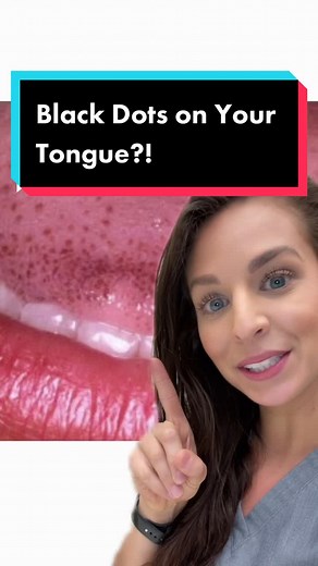 Black Spots on Tongue: Causes and Treatment