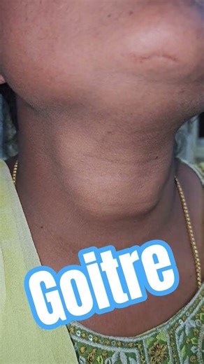 Goitre #imwell