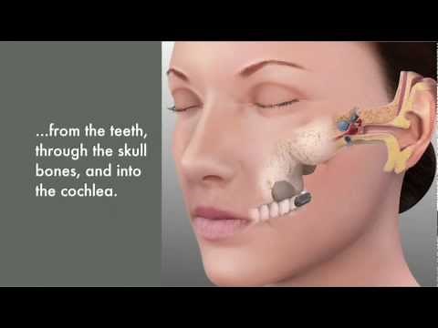 What is SoundBite™?