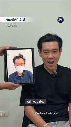 2 years post-hair transplant and I couldn't be happier—if I could go back in time, I’d do it agai...