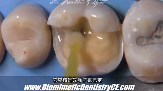 【张林】5天学会做嵌体4——即刻牙本质封闭（IDS）