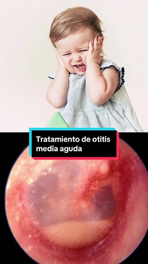 Tratamiento de Otitis Media Aguda Bacteriana