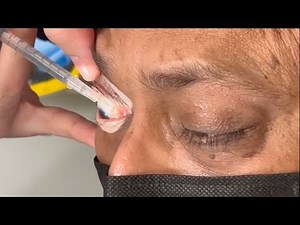 In-Office Suprachoroidal Viscopexy for Acute Rhegmatogenous Retinal Detachment, Patient 5