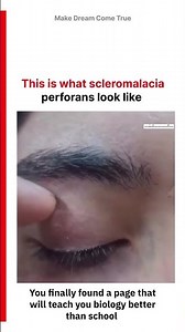 👁️This is what 🕳️scleromalacia perforans 💊 look like 🩺 | MDCT