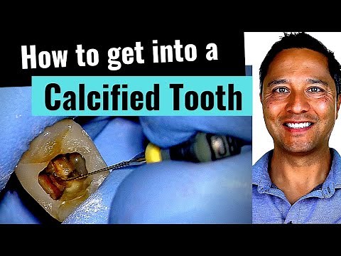 Calcified Tooth (How to Root Canal -Critical Tips!)