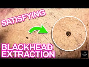 Blackhead Extractions | Satisfying Videos | NILUFER ESTHETICS SPA