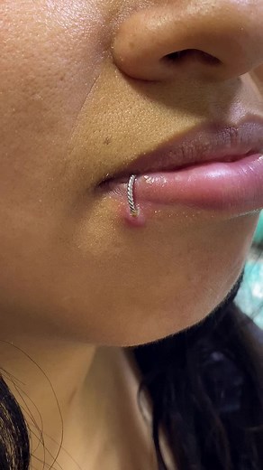 Piercing en el labio: Joya Incorrecta e Infección Inminente